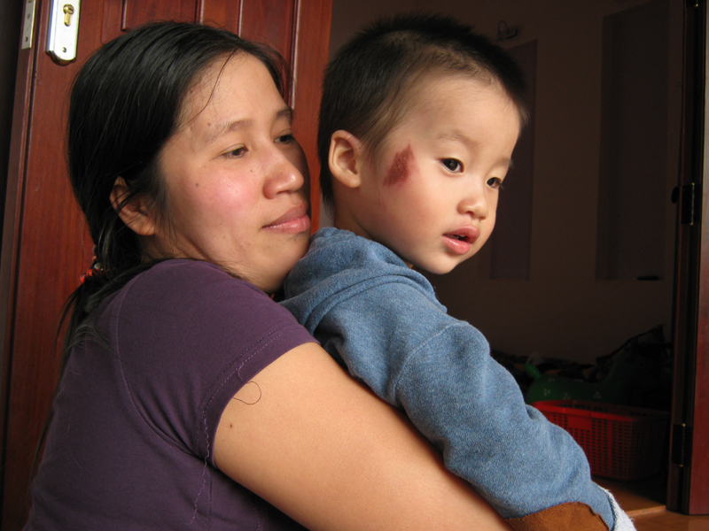 Cháu Nguyễn Quang Huy bị đánh trên mặt