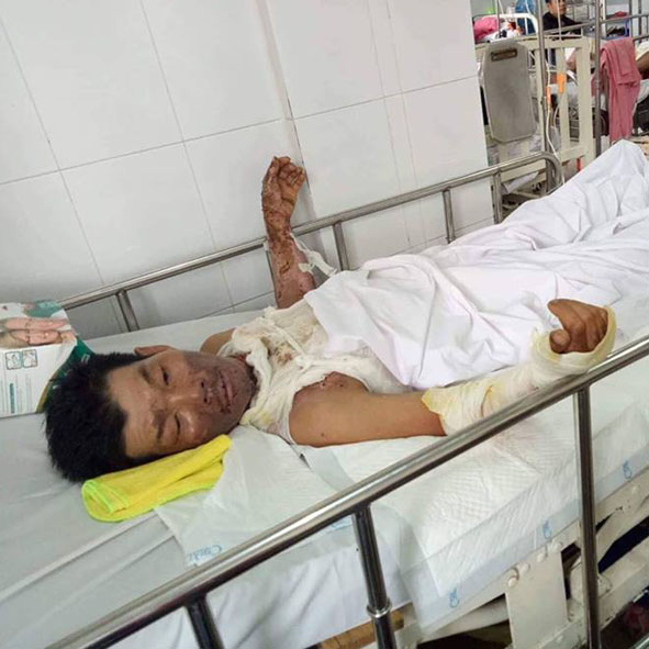Anh Súy bị điện giật cháy toàn thân.